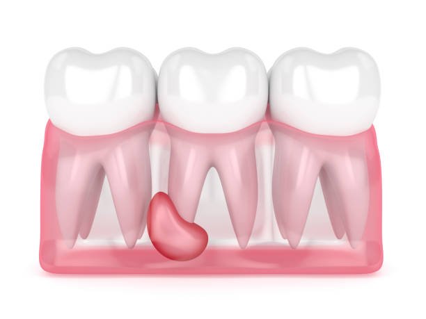best-Dental-Treatment-in-Mumbai-dr-tofiq-bohra-min 4-min