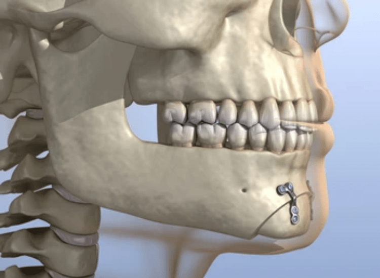 Best-Chin Surgeon-in Mumbai-dr-Tofiq bohra-min