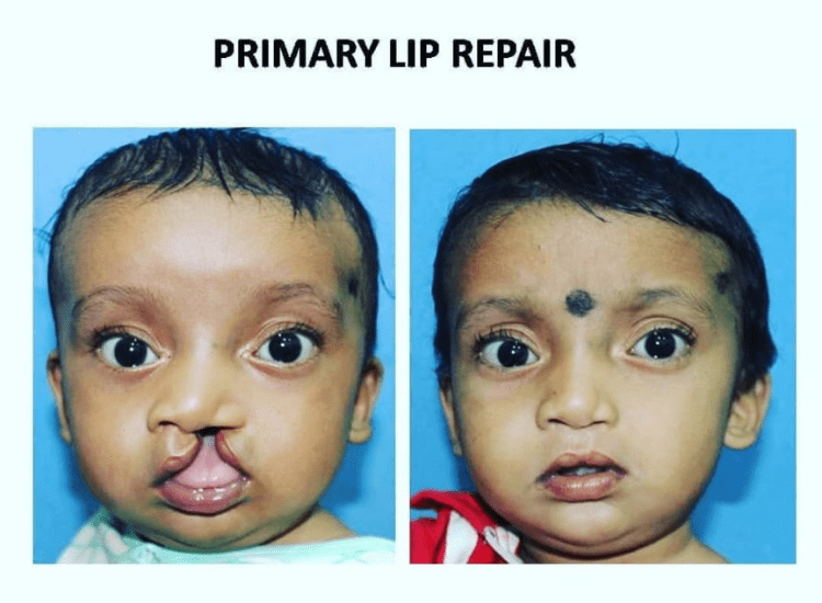 Best-Cleft-Surgeries-in-Mumbai-dr-Tofiq-bohra 2-min