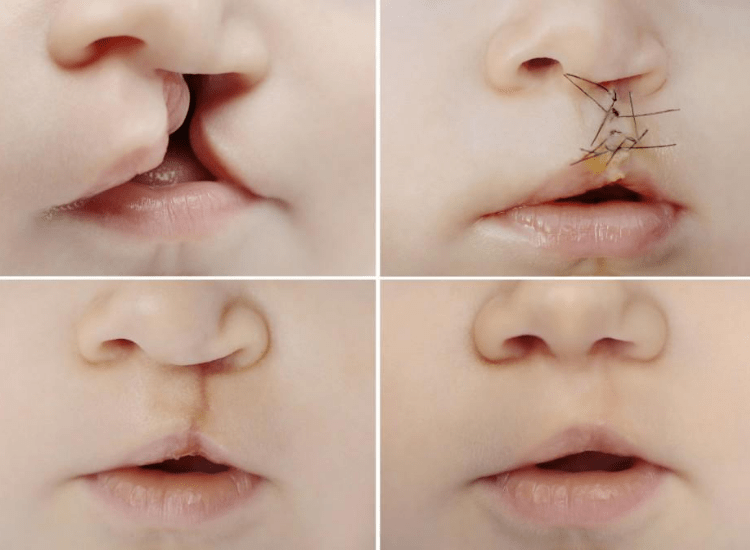 Best-Cleft-Surgeries-in-Mumbai-dr-Tofiq-bohra 2-min