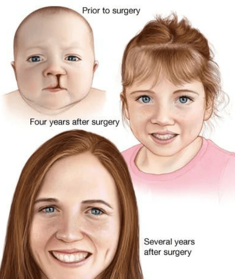 Best-Cleft-Surgeries-in-Mumbai-dr-Tofiq-bohra 2-min