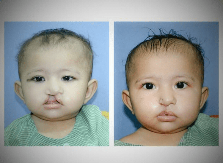 Best-Cleft-Surgeries-in-Mumbai-dr-Tofiq-bohra 2-min