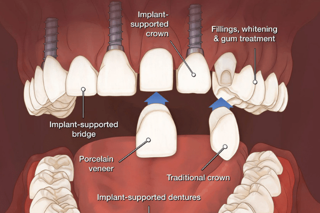 dr-tofiq-bohra-best-full-mouth-rehabilitation-treatment-in-mumbai