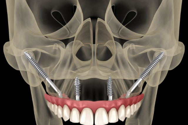 dr-tofiq-bohra-best-zygoma-Implants-treatment-in-mumbai