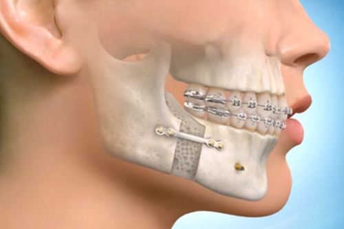 Best-Oral-Surgeon In-Mumbai-for-Jaw-Surgery