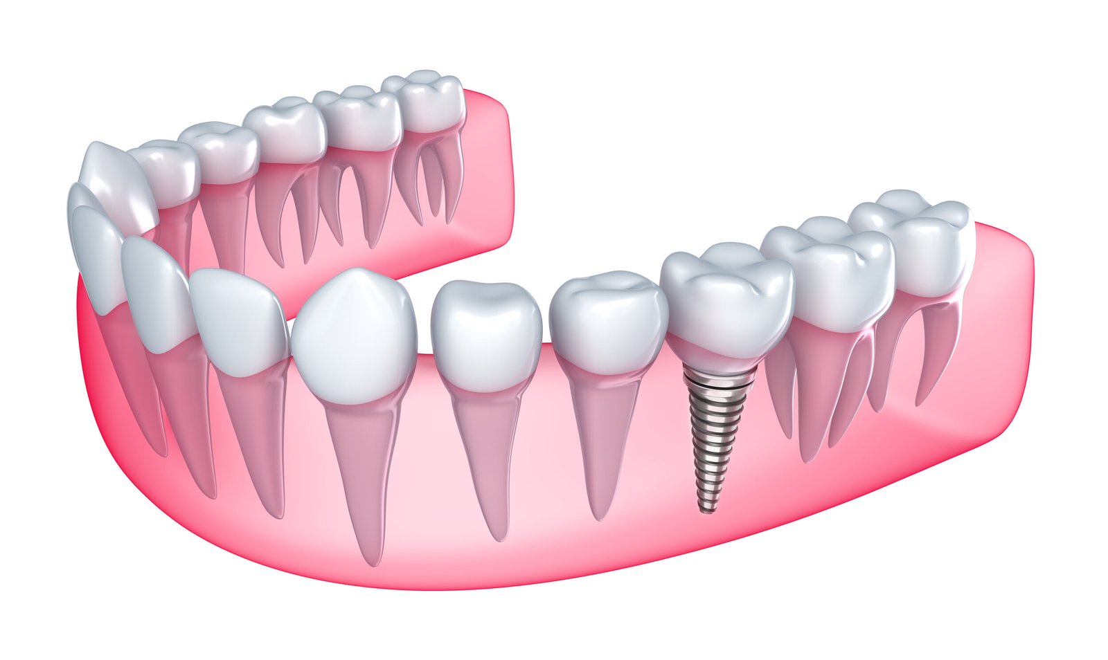 best-dental-implant-clinic-in-Mumbai