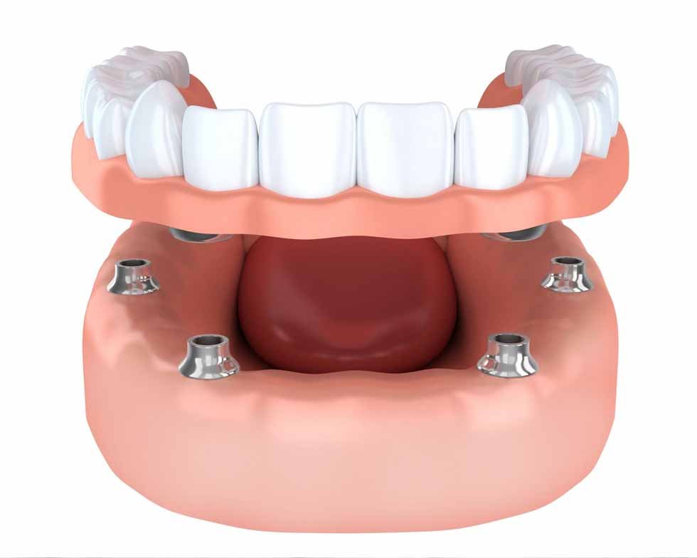 best-dental-implant-clinic-in-mumbai