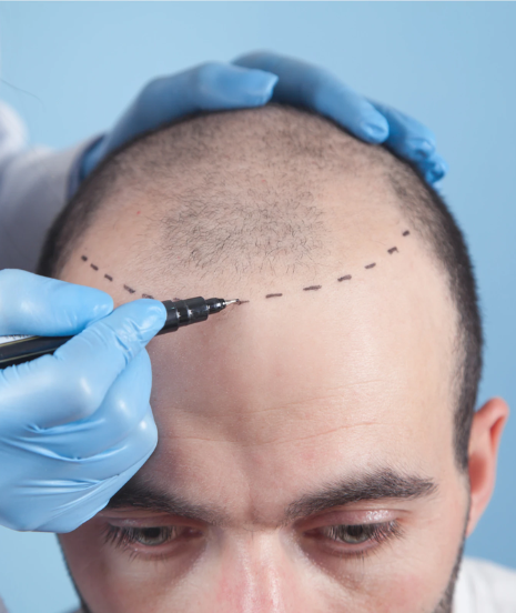 Hair Transplant Procedure by Dr. Tofiq Bohra